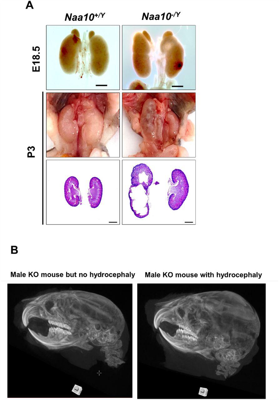 ... 11 examined). (B) Hydrocephaly (n=3 CT scans for Naa10 -/Y mice with hydrocephaly compared to n=3 Naa10 ... (A) Representative images and histology of renal defects at E18.5 (n=6 out of 39 examined) and P3 (n= 4 out of 11 examined). (B) Hydrocephaly (n=3 CT scans for Naa10 -/Y mice with hydrocephaly compared to n=3 Naa10 -/Y mice without hydrocephaly). (C) Kaplan-Meier survival curve of the Naa10 +/Y and Naa10 -/Y male mice starting at 4 days of life, thus not including any mice that died in the first 3 days of life.
