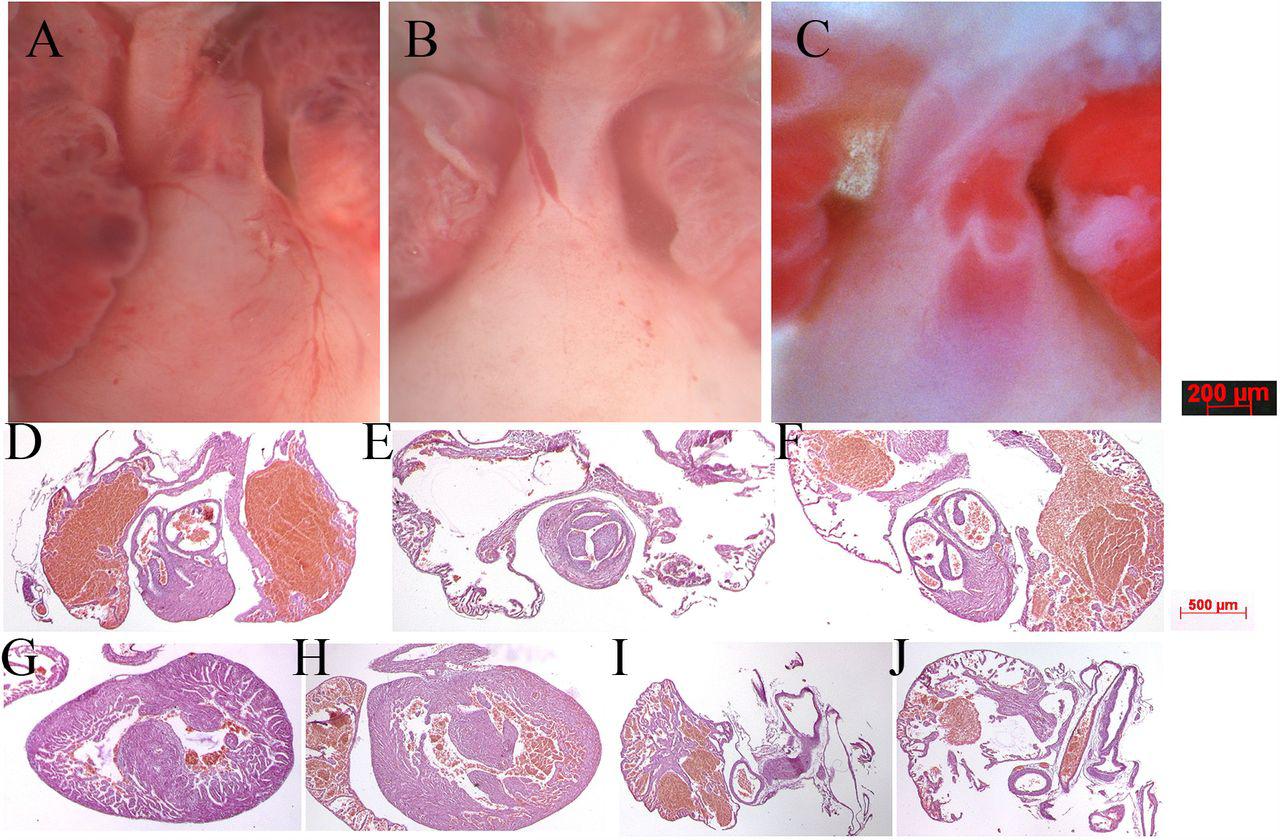 ... trunks nestled between left and right atria. (B) Naa10 -/- female heart from dying P0 pup only ... (A) Wildtype male heart outflow tract region indicating separate aorta and pulmonary trunks nestled between left and right atria. (B) Naa10 -/- female heart from dying P0 pup only has a single outflow tract emerging from the right ventricle, resulting in persistent truncus arteriosus. (C) Naa10 -/y male heart from dying P0 pup has separate outflow tracts but both emerge from the right ventricle, resulting in double outlet right ventricle. (D) normal histology from wildtype male heart of pulmonary artery exiting the right ventricle. (E) histology from Naa10 -/- heart of single outflow tract exiting the right ventricle with tricuspid valve leaflets. (F) histology from Naa10 -/y heart of both pulmonary and aortic arteries emerging from right ventricle within the same plane. (G) Naa10 -/- histology showing membranous VSD, (H) Naa10 -/y histology showing muscular VSD. (I) normal heart revealing closed ductus arterious, (J) Naa10 -/- histology showing open ductus arterious leading to pulmonary overload and likely lethality.
