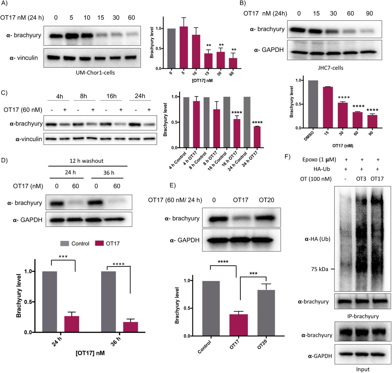 ... 24 h, subjected to lysis and analyzed for brachyury downregulation. Brachyury levels were normalized to loading control ... A) Increasing concentrations of OT17 were transfected into UM-Chor1 cells and harvested after 24 h, subjected to lysis and analyzed for brachyury downregulation. Brachyury levels were normalized to loading control and presented as a bar graph. B) JHC-7 cells were transfected with OT17 and probe for brachyury levels as explained in (A). C) UM-Chor1 cells were transfected with 60 nM of OT17 and harvested at subsequent different time points as indicated. D) Washout experiment: transfection medium was removed after 12 h of OT17 transfection and UM-Chor1 cells were incubated for another 12 h or 24 h in fresh complete cell culture medium. E) OT17-mediated brachyury degradation is oligonucleotide sequence dependent. UM-Chor1 cells were transfected with OT17 and scrambled OT20, cells were lysed and analyzed as shown. F) OT3- and OT17-induced brachyury ubiquitination. HEK293T cells that overexpress brachyury-GFP were transfected with HA-ubiquitin, followed by the second transfection with OT3 or OT17. After 12 h, cell lysates were subjected to immunoprecipitation using brachyury antibody, and the eluates blotted for the indicated proteins.