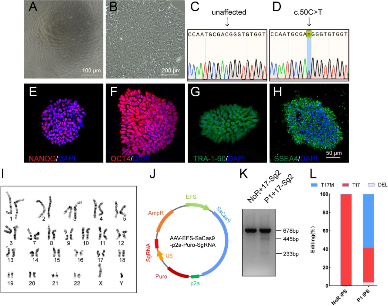 Determination of specificity and cutting efficiency of SaCas9 and sgRNA in induced pluripotent stem cells (iPSCs) from patients’ urine cells (UCs). (A)Photograph of UCs. Scale bar=100 μm. (B) Photograph of iPSCs. Scale bar = 200 μm. (C-D) Sanger sequencing results showed that P1 iPS had the heterozygous c.50C>T mutation. IF staining showed the iPSCs expressed human embryonic stem cell-specific surface antigens including NANOG (E), OCT4 (F), TRA-1-60 (G) and SSEA-4 (H) protein. (I) Chromosomal content analysis revealed a normal 46, XY karyotype of patient P1. (J) Schematic view of AAV-EFS-SaCas9-U6-sgRNA-p2a-Puro plasmid. (K) T7E1 assay indicated that SaCas9/17-Sg2 was appeared to cut the mutant sequence specifically. (L) The cutting efficacy of SaCas9/17-Sg2 is determined by TA & Sanger sequencing in iPSCs.