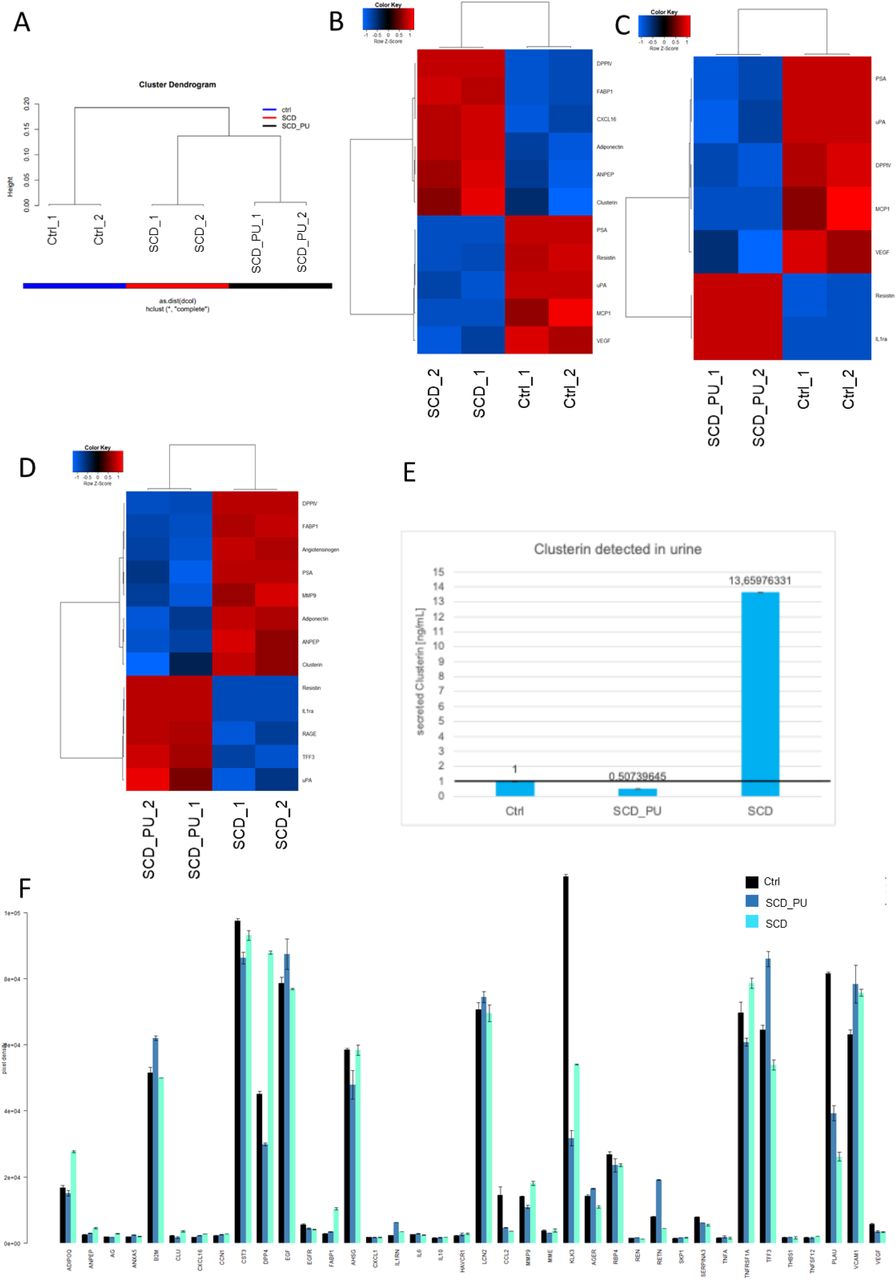 Pooled urine samples of SCD with and without Proteinuria were analyzed on the Human Kidney Biomarker Array. (A) The cluster dendrogram shows separate clusters of SCD with PU (SCD_PU), SCD without PU (SCD) and healthy control (Ctrl). (B) The heatmap shows expression of differentially expressed proteins between SCD and Ctrl. (C) The heatmap shows expression of differentially expressed proteins between SCD_PU and Ctrl. (D) The heatmap shows expression of differentially expressed proteins between SCD_PU and SCD. Resistin, IL1RA, RAGE, TFF3 and uPA (PLAU) are up-regulated in SCD_PU while DPPIV, FABP1, Angiotensinogen, PSA (KLK3), MMP9, Adiponectin, ANPEP and <t>Clusterin</t> are down-regulated. (E) The bar chart of ELISA measurements confirms higher expression of Clusterin in SCD than in control but lower expression in SCD_PU than in control. (F) The bar plot shows the absolute expression of all proteins on the Human Kidney Biomarker Array. 