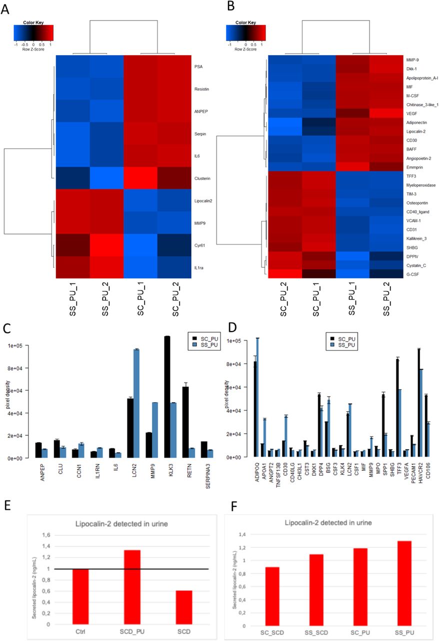 Pooled urine samples of genotypes SS and SC from SCD patients with and without Proteinuria were analyzed on the Human XL cytokine and kidney biomarker arrays. (A) The heatmap shows expression of differentially expressed kidney injury marker proteins between SCD_PU patients with the genotypes SS and SC. (B The heatmap shows expression of differentially expressed cytokines between SCD_PU patients with the genotypes SS and SC. (C) The bar plot shows expression of differentially expressed kidney injury marker proteins between SCD_PU patients with the genotypes SS and SC. Lipocalin-2 (LCN2 / NGAL), MMP9, CCN1 and IL1RN (IL1RA) are up-regulated in SS_PU while ANPEP, CLU (Clusterin), IL6, KLK3, RETN and SERPINA3 are down-regulated in SS_PU. (D) The bar plot shows expression of differentially expressed cytokines between SCD_PU patients with the genotypes SS and SC. Amongst the cytokines up-regulated in SS_PU, the increased levels of LCN2 and MMP9 were also confirmed in the kidney biomarker array. (E) Up-regulation of the established kidney injury marker LCN2 (NGAL) between SS_PU and SC_PU (C) was confirmed by ELISA in SCD_PU vs SCD and between SS_PU and SC_PU (F). 